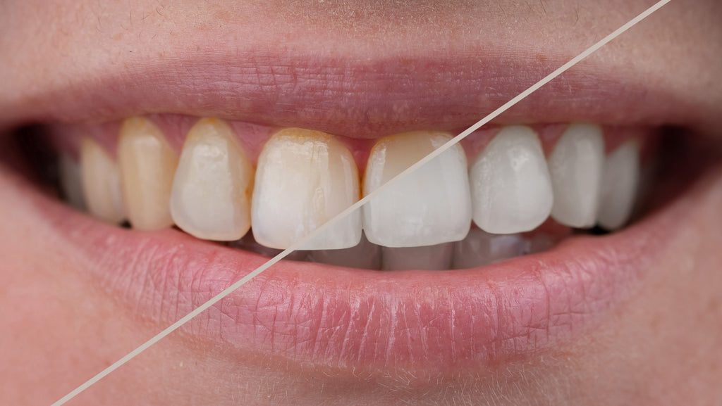 what-is-fluorosis-and-how-you-can-avoid-it-keeko-oral-care