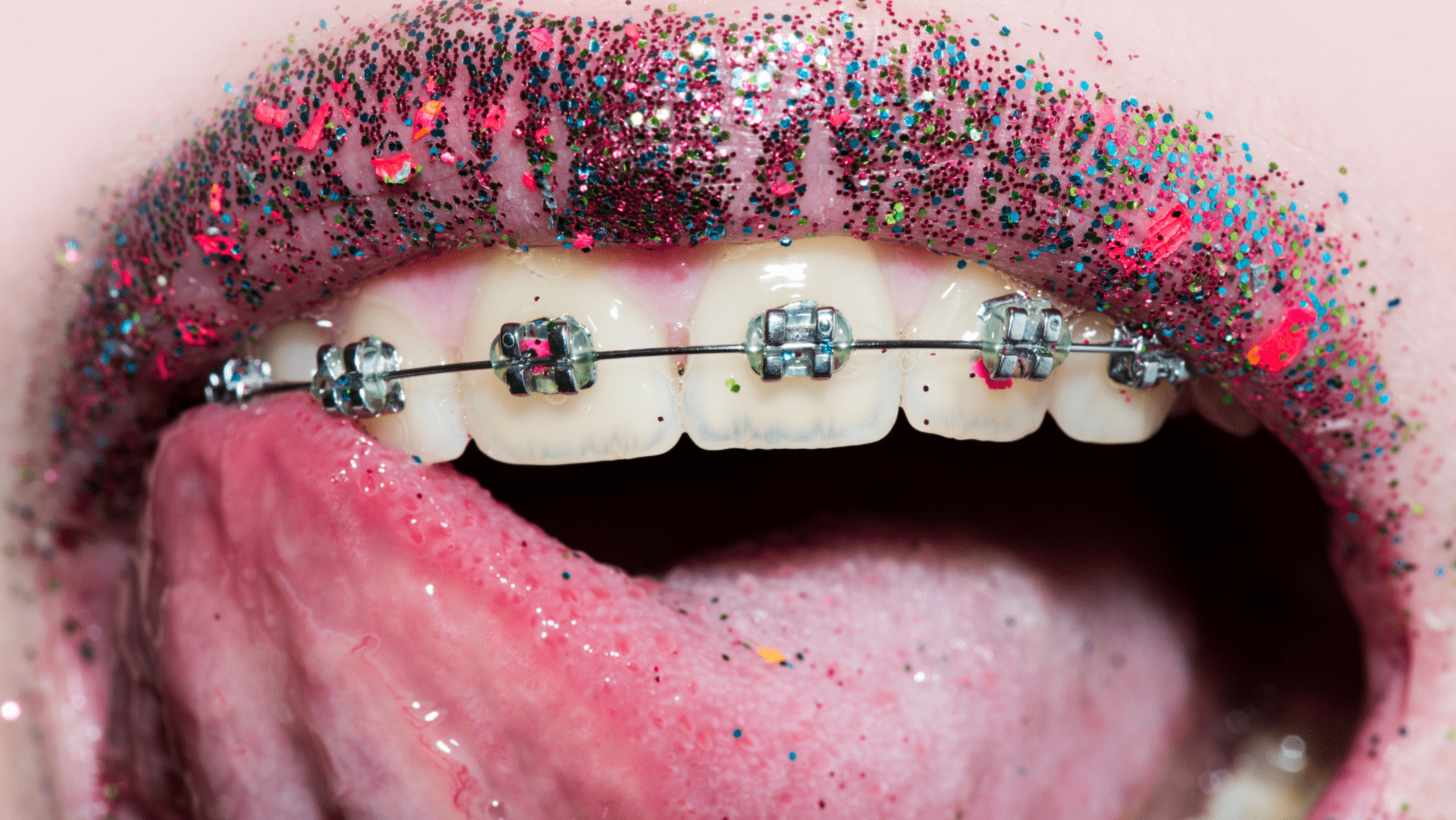 hot pink braces tumblr